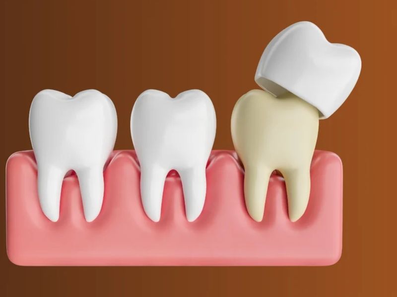 Illustration of a dental crown being placed over a prepared tooth between two healthy teeth
