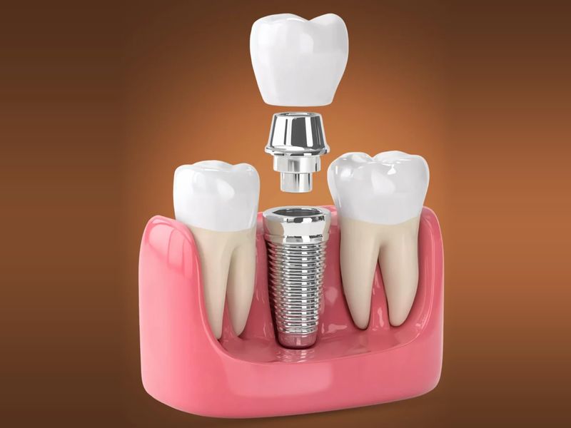 Illustration of a dental implant with abutment and crown between two natural teeth