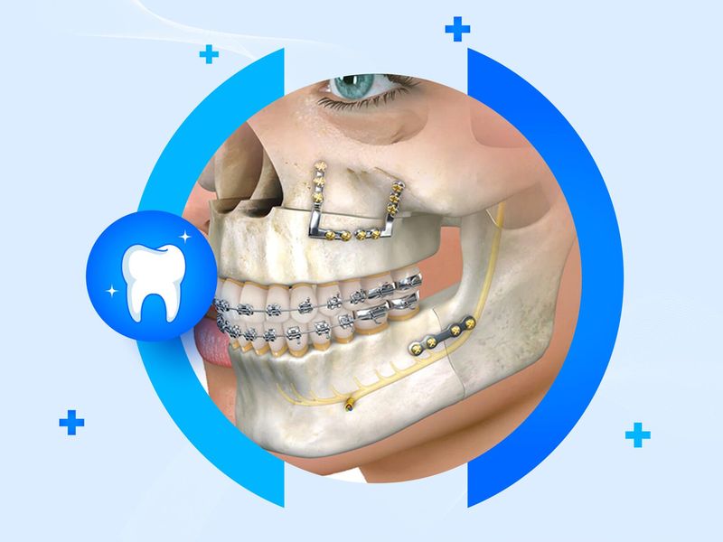 Illustration of facial bone fractures fixed with plates and screws