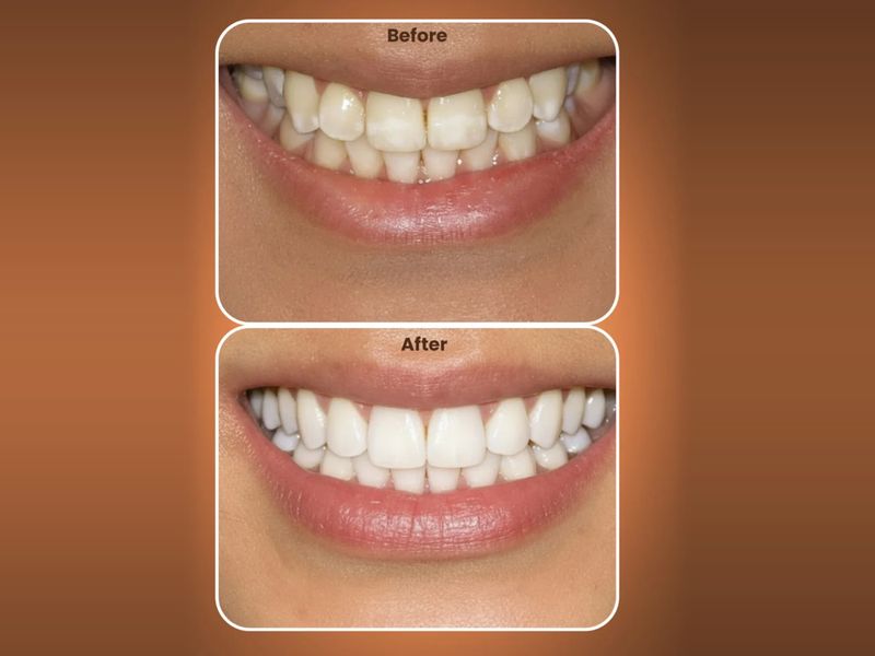 Illustration of stained teeth before and after cosmetic treatment