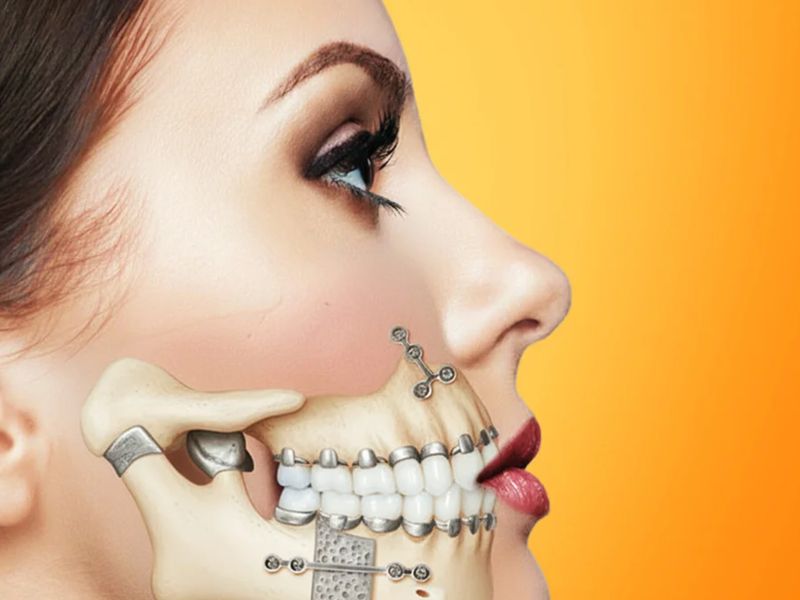 Illustration of jaw bones fixed with plates after corrective jaw surgery