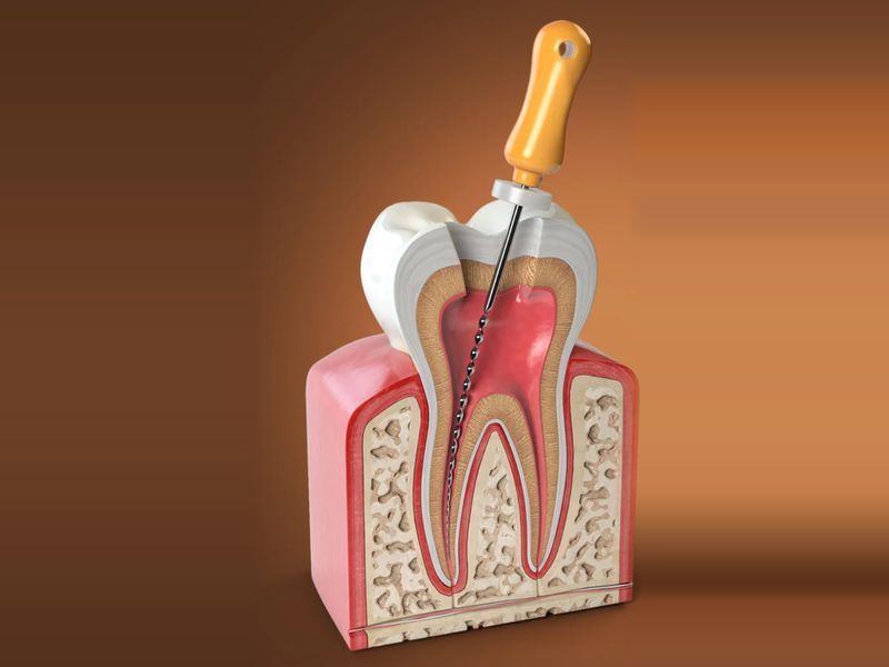 Cross-section illustration of a tooth during root canal treatment