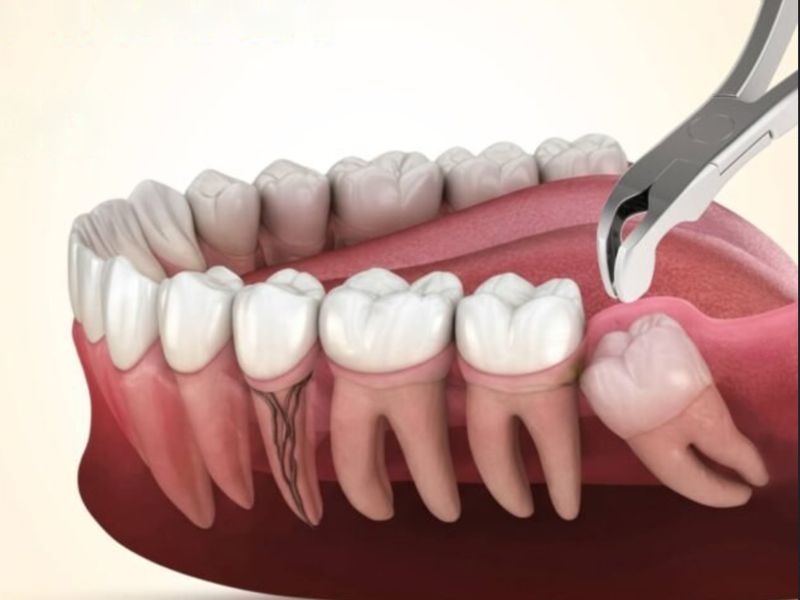 Illustration of an impacted wisdom tooth being removed with dental forceps